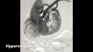 Renal Angiomyolipoma AML Transcatheter Ethanol Alcohol Embolization [upl. by Laumas]