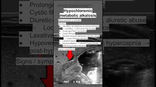 Hypochloremic metabolic alkalosis [upl. by Frederich]