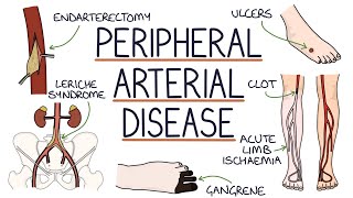 Understanding Peripheral Arterial Disease [upl. by Tania]