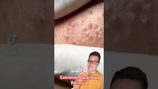 EXTREME BLACKHEAD REMOVAL  Blackhead Popping At Its Best shorts [upl. by Eneluj]