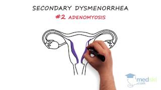 Obstetrics and Gynecology – Dysmenorrhea By Paul Davies MD [upl. by Etteiluj]