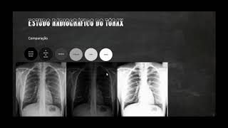 Radiologia  Técnicas de kV associado a qualidade das imagens [upl. by Gnuoy]