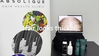 Hair Transformation Two Weeks into Womens Hair Loss Treatment [upl. by Aylward]