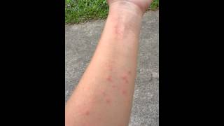 Never thought suffer this ITCHY rashes after back from Botanic Garden [upl. by Ajed]