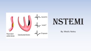 NSTEMI nonST elevation myocardial infarction  investigations management [upl. by Uni]