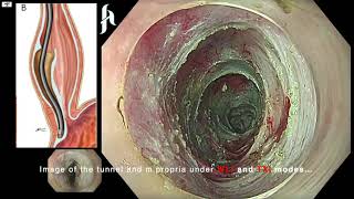 POEM for achalasia treatment with EVISX1OlympusTXI WLI RDI from Fatih Aslan Akalazya ve POEM [upl. by Anawal]