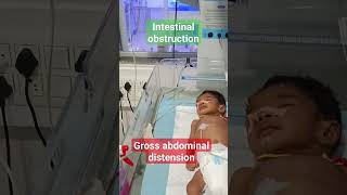 intestinal obstruction infant abdominal distension sepsis [upl. by Goodhen611]