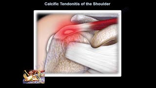 Calcific Tendonitis of the shoulder  Everything You Need To Know  Dr Nabil Ebraheim [upl. by Rosmunda514]