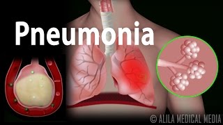 Pneumonia Animation [upl. by Purdum]