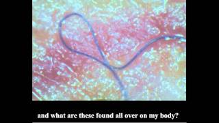 Morgellons the TRUTH [upl. by Ovid]