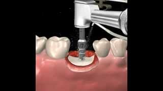 Step by step dental implant surgery Gary R OBrien DDS [upl. by Vaules]