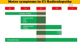 C7 Radiculopathy [upl. by Aronow709]