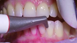 How teeth should be cleaned at the Dentist  Hygienist [upl. by Seiden]