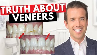 Before you get Dental Veneers Watch This  Are Veneers Worth It [upl. by Tteraj301]