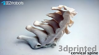 3D Printed Cervical Spine [upl. by Arrimat225]