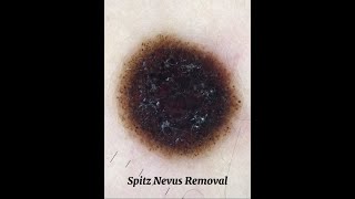 Spitz Nevus surgical removal [upl. by Anawyt]