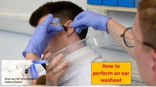 How to Perform an Ear Washout irrigation  ENTOtolaryngology Skills [upl. by Lyrac322]