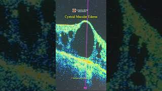 Cystoid Macular Edema OCT [upl. by Ahsemat870]