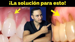 Retracción de encía y Desgaste en cuello de los dientes ¿Cómo se soluciona y qué lo provoca [upl. by Adkins]