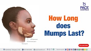 How Long does Mumps Last  mumps shorts viralvideo [upl. by Steady655]