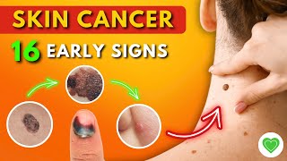 16 Early Signs of Skin Cancer You Should Never Ignore  Melanoma  Skin Cancer Symptoms [upl. by Proulx]