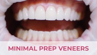 Minimal Preparation Porcelain Veneers Smile Transformation [upl. by Goldy]