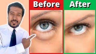 How to Get Rid of Puffy Eyes and Bags in 5 Fast Steps [upl. by Mendelsohn]