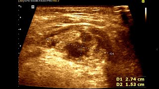 Submental Salivary Abscess  Sialolithiasis [upl. by Duff]