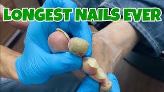 SUPER SATISFYING DEBRIDEMENT OF TOENAILS FOR DAYS 🤯😱 [upl. by Naryb]