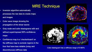 MR Elastography of Liver Technique Interpretation amp Applications Dr Naveen Kalra PGI Chandigarh [upl. by Nafets]