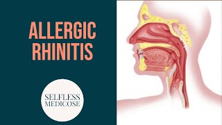 ALLERGIC RHINITIS complete explanation part 2 [upl. by Aihtniroc466]