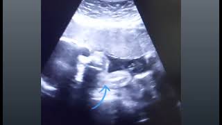 Anterior placenta with 28 weeks baby movements gender amp 3VCord  8 weeks pregnancy with heartbeat [upl. by Itsim]