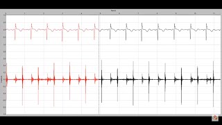 Holosystolic murmur in a child with a membranous ventricular septal defect [upl. by Aylmar]