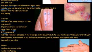 99P Psoriatic Arthritis quotpencil in cupquot deformity [upl. by Apurk949]