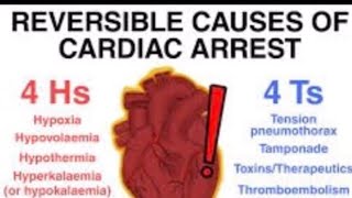 Reversible Causes of Cardiac Arrest 4 H’s Hypoxia Hypothermia Hypovolaemia HyperHypokolaemia [upl. by Prochoras]