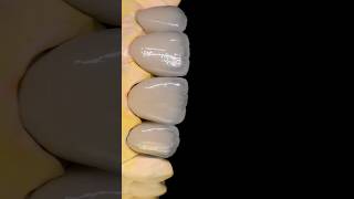 CC Creation  Mamelon anatomy topdental dentalclinic dentalcenter shorst [upl. by Wanda]