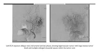 Percutaneous nBCA glue embolization of skull base tumor [upl. by Kilby]