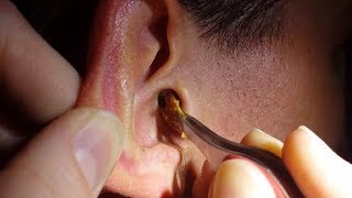 Top Remedies To Get Rid Of Clogged Ear Easily [upl. by Naasah351]