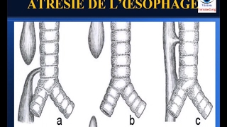 Atrésie de loesophage Diagnostic et Prise en Charge néonatale [upl. by Lessig]