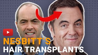 James Nesbitts Hair Transplant  The Complete Story [upl. by Otiragram]