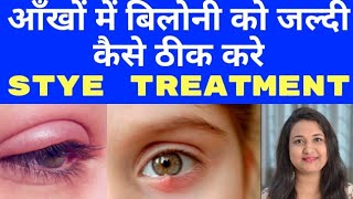 STYE ON EYELID  बिलोनी का होम्योपैथिक इलाज  FAST AND EFFECTIVE TREATMENT FOR STYE [upl. by Anierdna]