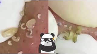 Ultimate Satisfying Pimple Popping Compilation 2024  Best Blackhead amp Acne Removal Video [upl. by Airod]