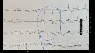 ECG week 20 STEMI OR NSTEMI [upl. by Eigla625]