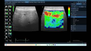 IQ 259 HEPATOMA ELASTOGRAPHY ECHOPAC ANALYSIS ULTRASOUND [upl. by Erlewine606]