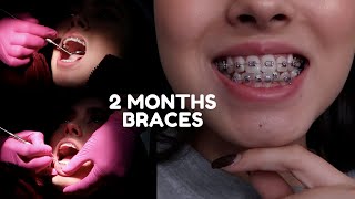 2 MONTH BRACES UPDATE  CHANGING WIRE VLOG [upl. by Arrekahs933]