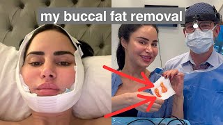 Getting my Buccal Fat REMOVED  Buccal Fat Removal Vlog [upl. by Stutman560]