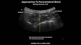 Approaches to paravertebral block [upl. by Balbinder]