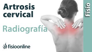 Artrosis cervical  Qué es y cómo se diagnostica en radiografías [upl. by Rab501]