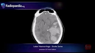 Stroke Lobar haemorrhage  radiology video tutorial MRI CT [upl. by Ludlew765]