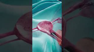 Hysteroscopy डिवाइस कैसा होता है Operative Hysteroscopy Procedure fibroid shorts animation [upl. by Yehsa50]